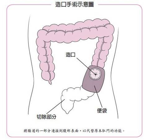 肛门切除后挂袋是什么样子