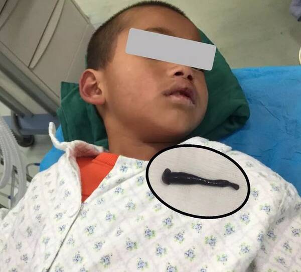 可怕!云南一男童声音嘶哑喘气困难,医生从他气