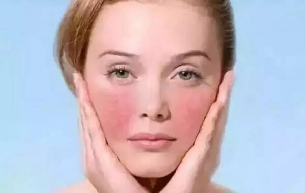 脸颊总像打了腮红,皮肤炎症告诉你可能患有……