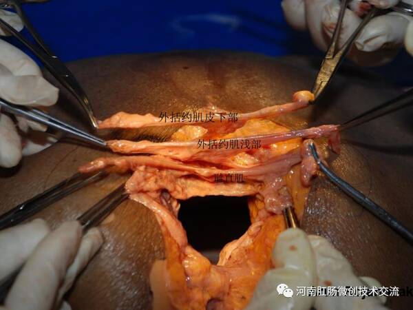 肛瘘手术图片 肛瘘手术过程图片_肛瘘手术痊愈后的图片
