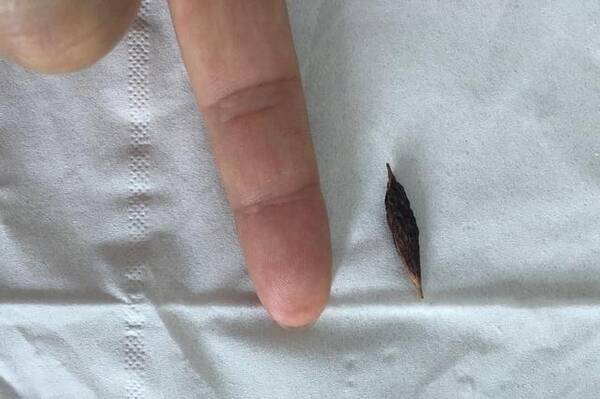 旬老人不慎吞下红枣核,最后肛周疼痛,要扩开肛