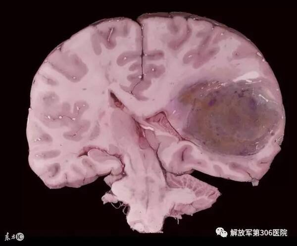 脑胶质瘤的治疗方法有哪些?