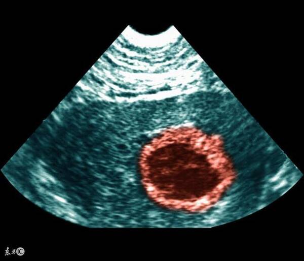 孕早期阴道出血=先兆流产?早孕见红有7种原