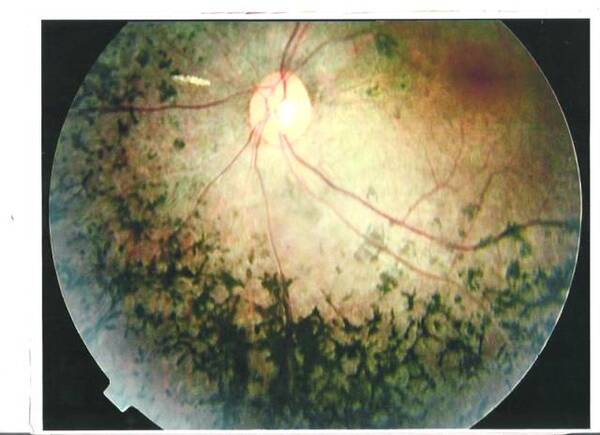 【眼科】这篇文章，为夜盲症、视网膜色素变性(RP)患者开启光明之门!