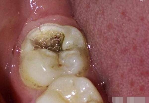 里面几颗大牙都有黑线,医生却不建议补牙?
