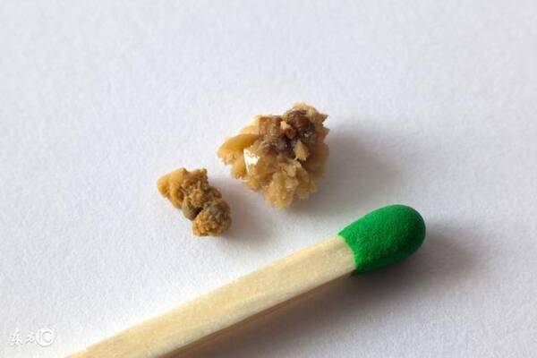 不花一分钱,每天做3个动作,肾结石就自己排出来