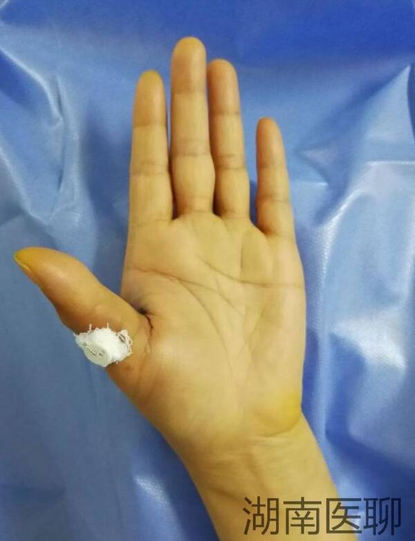 多图:手指戳伤伸不直,记录治疗全过程!