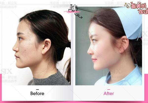 朋友做自体脂肪面部填充失败了，真替她担心