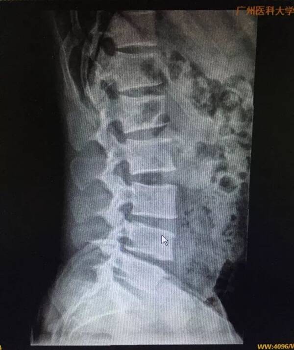 面对脊柱病，中医能做到什么程度?