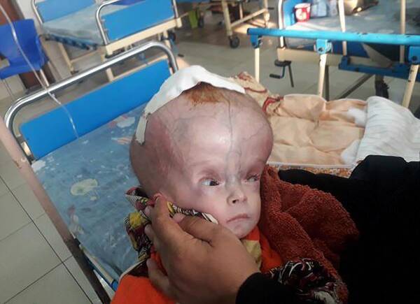 9个月大的男婴患怪病,头围达63.5cm,如同一个