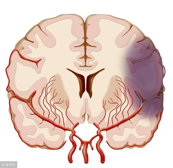 短暂性脑缺血发作的症状与原因