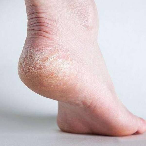 脚后跟脱皮粗糙有裂口?5招去死皮去角质,让你足部光滑性感
