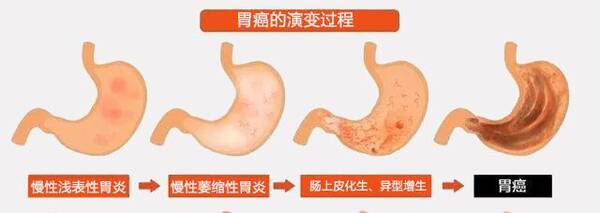 胃黏膜肠上皮化生一定会得胃癌吗?哪种情况属