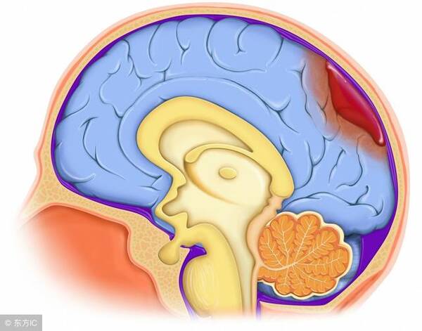 脑出血图片