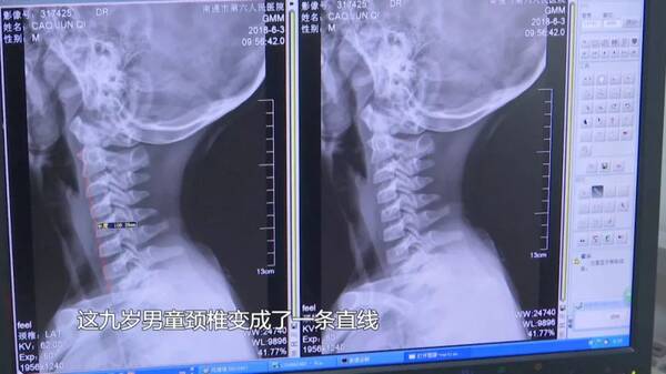 学生检查颈椎做什么_颈椎有问题做什么检查