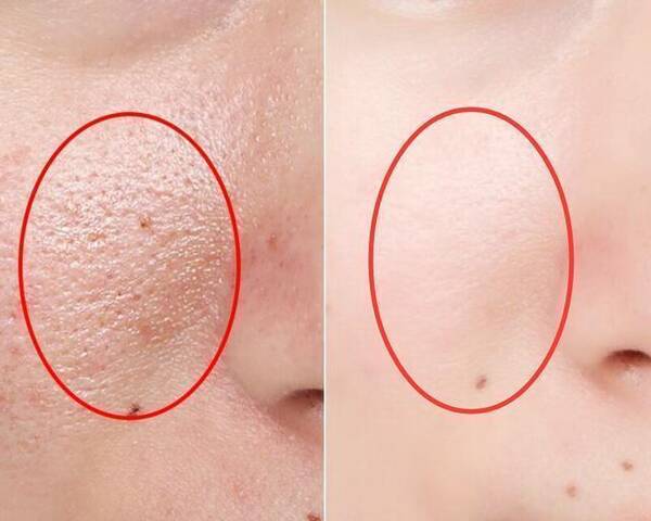 皮肤变得暗沉粗糙还瘙痒?那是螨虫在作怪,3招去螨虫皮肤更细腻