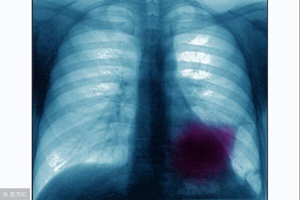 肺肿瘤的护理方法都有啥?常吃芦笋可抑制肺癌