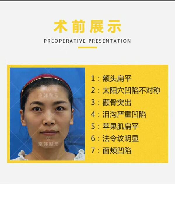 图片北京做的脂肪填充已经完全恢复王沛森案例