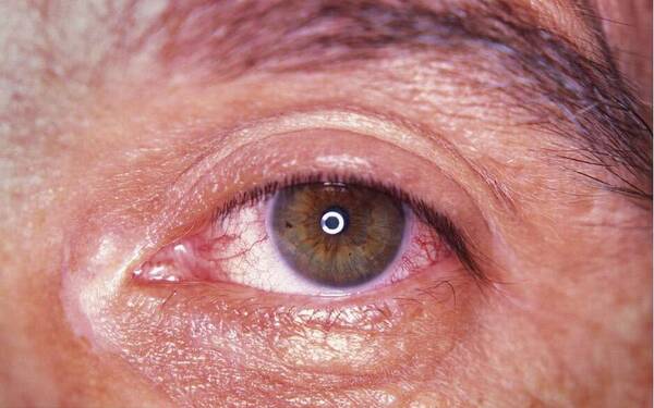 肝脏中毒会有什么表现 眼睛出现血丝要小心了