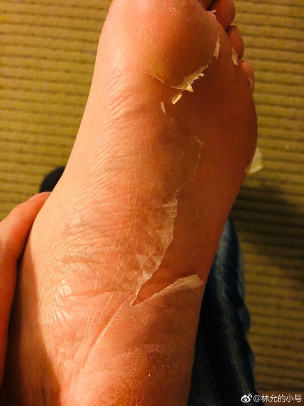 林允敷脚膜画面太吓人，整个脚脱皮网友看着都喊痛!