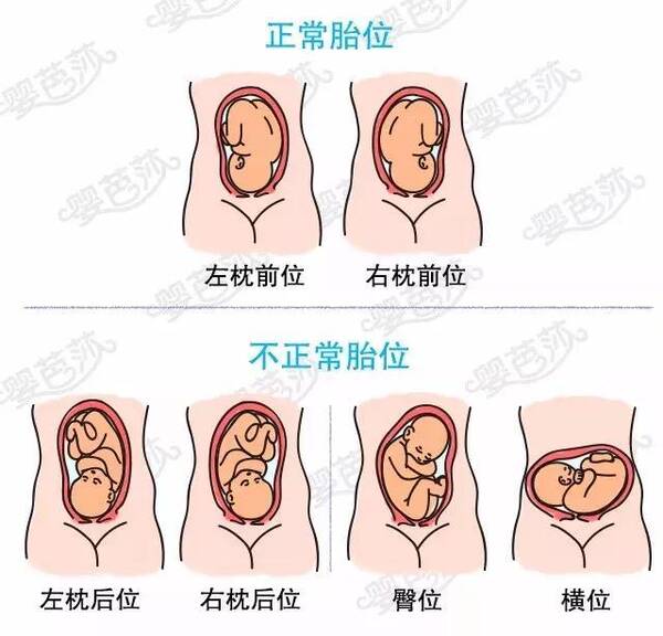 如枕先露时,枕骨位于骨盆入口左前方时为左枕前位,是最常见的一种胎位