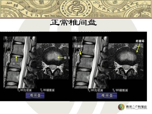 脊柱常见疾病的MRI诊断#医学影像经典PPT#