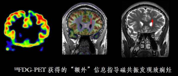 癫痫患者迎来新曙光!浙大专家团队精准定位癫