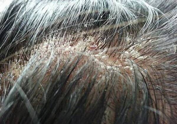 头屑超多、头皮瘙痒、什么样的洗发水都没效果!皮肤科医生来支招