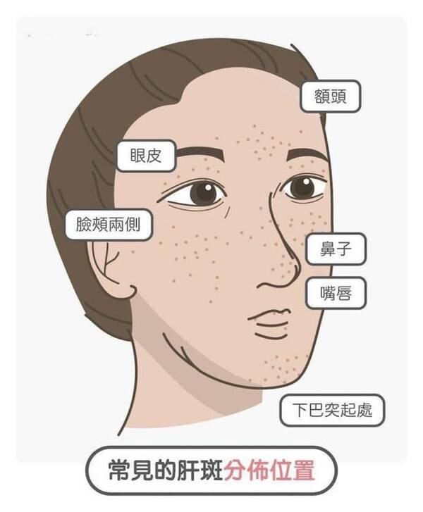 额头长黄褐斑是什么原因引起的
