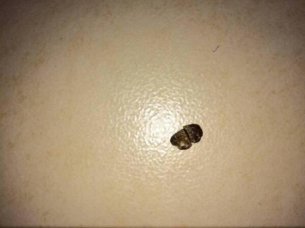 2cm肾结石怎么处理?如果不想手术用这方法,根