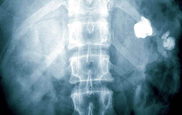 2cm肾结石怎么处理?如果不想手术用这方法,根
