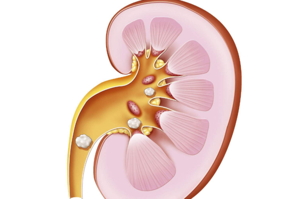 2cm肾结石怎么处理?如果不想手术用这方法,根