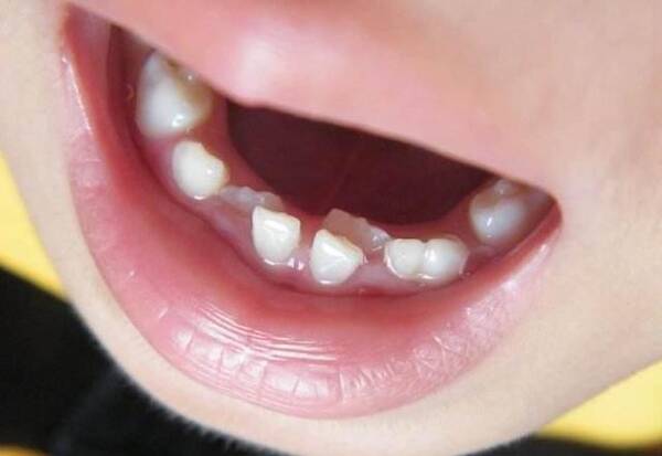 怎样可以预防小朋友牙齿不齐呢?
