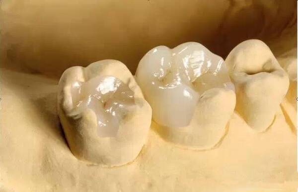 如何判断蛀牙是否要做根管治疗?