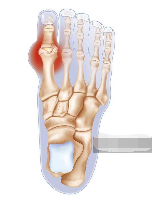 痛风晚期的先兆和和三个重要特征,记住这件事