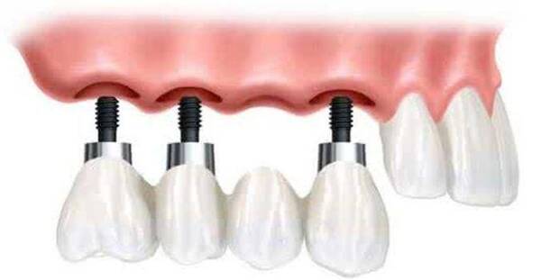 成都多颗缺牙市民,种牙好还是镶牙好?