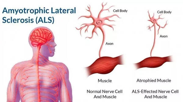 前沿| 抗炎治疗与ALS新药--专访哈佛免疫学专家