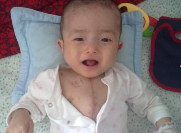 3岁宝宝患鸡胸,医生一席话,让妈妈很惭愧