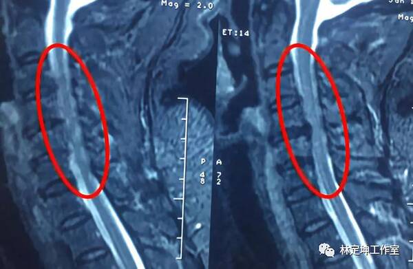 谈骨论筋 | 脊髓型颈椎病得赶紧手术?这些症状