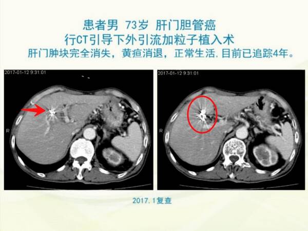 大家见过的癌症晚期病人,最长的活了多久?