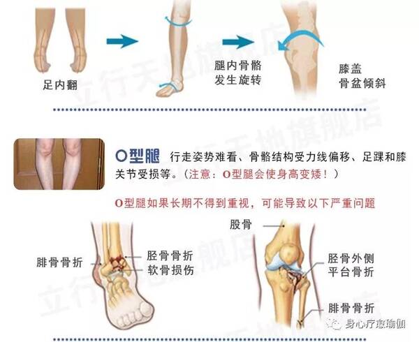 24岁了从小得了先天性马蹄足内翻,现在还可以治疗吗