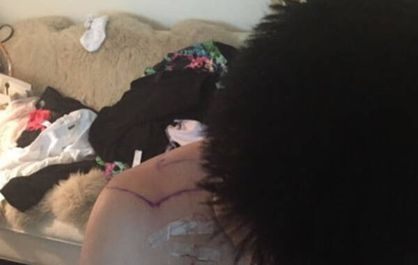 京时间5月10日消息，马布里在微博上贴出了孙悦肩部手术伤口细节的照片。伤口将近15公分，紫痕骇人。
