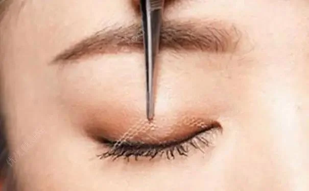 常州曙光美容医院做双眼皮好么？常州眼部整形专业医院丨常州曙光医院做双眼皮怎么样