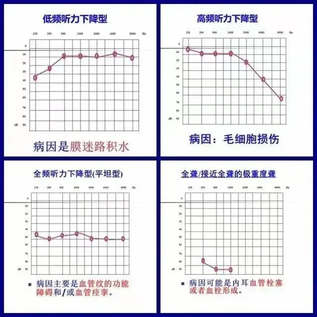 耳朵听力不好怎么治？来成都民生耳鼻喉医院帮你摆脱突发性耳聋(图2)