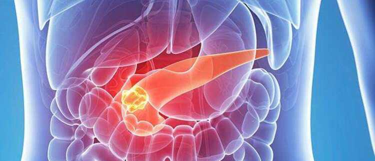 中国科学家发现胰腺癌元凶