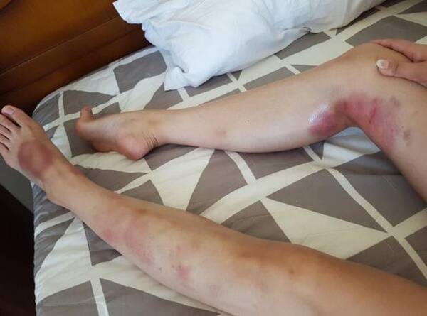 敬业!韩女星跳钢管热舞后 白皙双腿淤青吓人