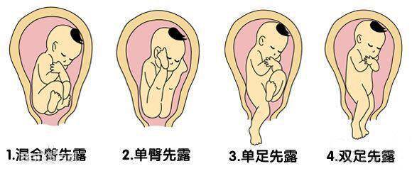 让准妈妈知道巨凶险的臀位分娩,吓到众人!