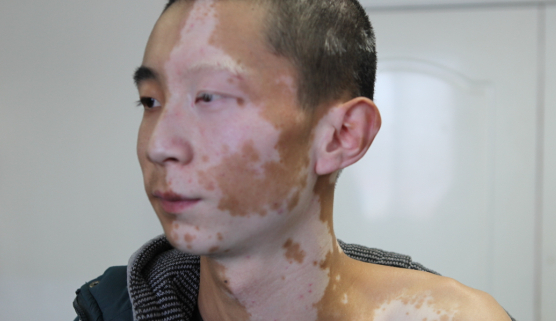 面部白癜风对患者的心理危害有哪些