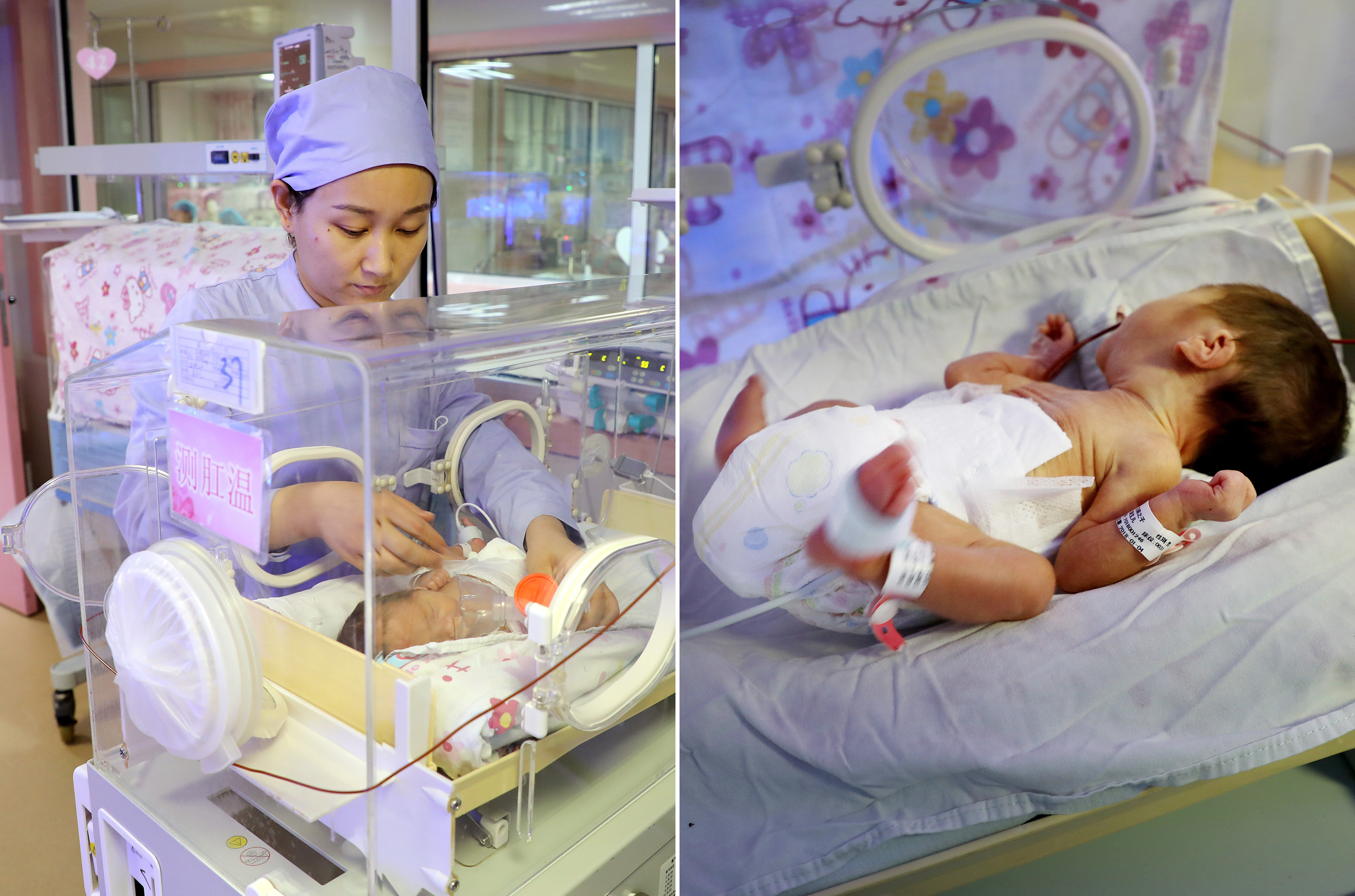 罕见双胞胎大双早产夭折小双13天后平安降生