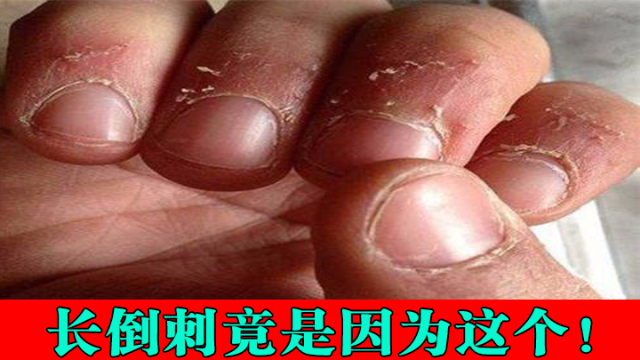 手上长倒刺的真凶竟是洗手液告别倒刺只需一招